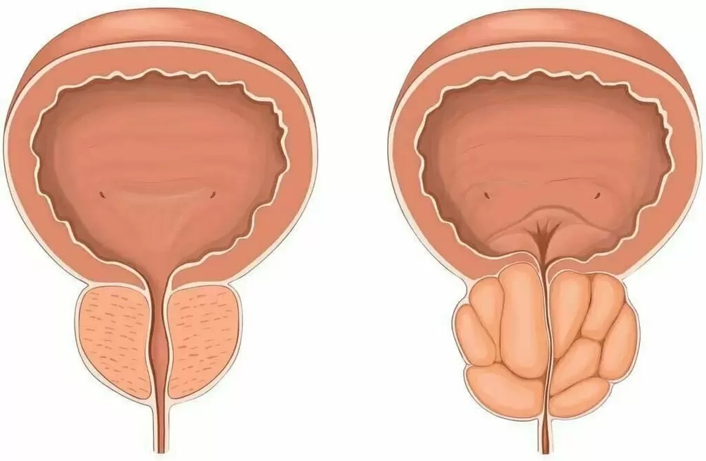 normāla prostata un slima prostata